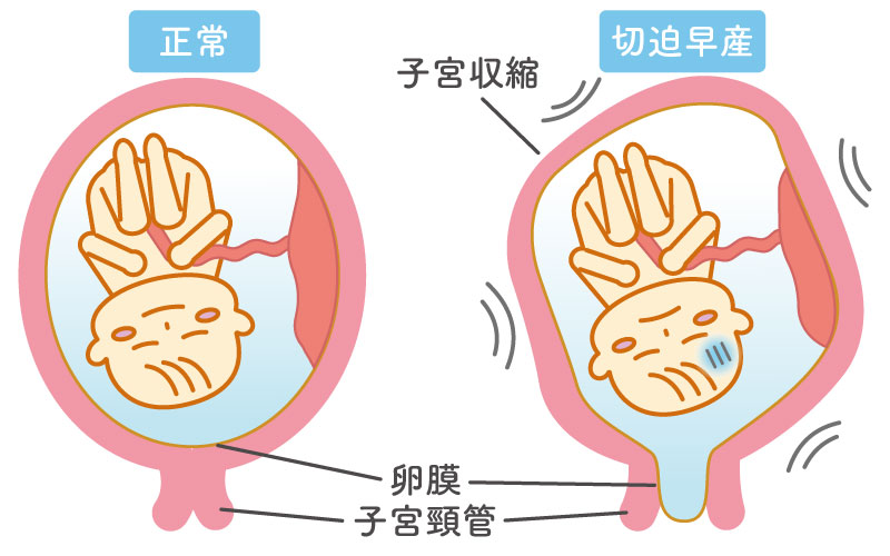 切迫早産の原因や症状、治療法や過ごし方について。早産との違いも解説 | 産婦人科「札幌みらいクリニック」