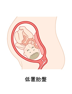 低置胎盤