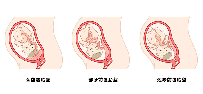 全前置胎盤、部分前置胎盤、辺縁前置胎盤