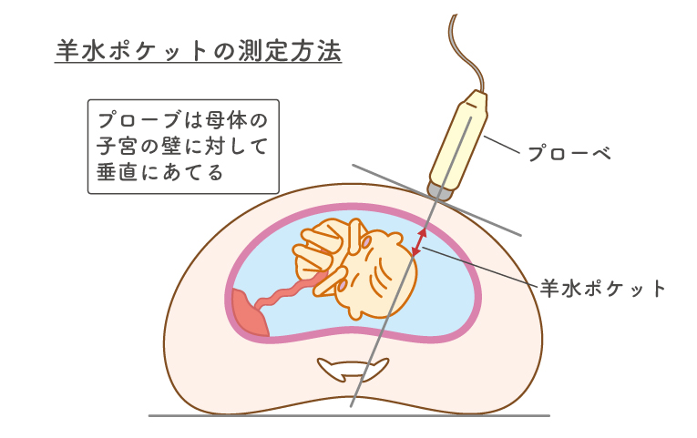 羊水ポケットの測定方法