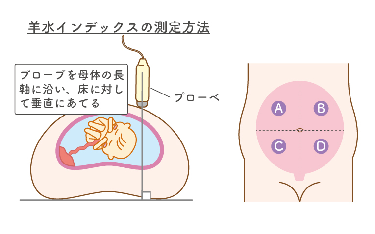 羊水インデックスの測定方法