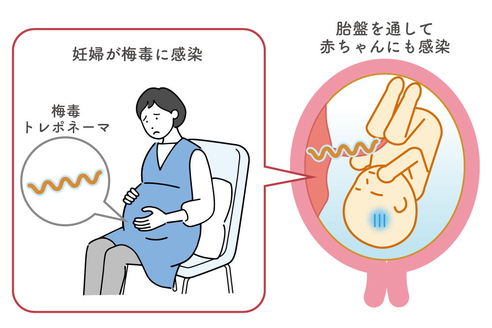 先天梅毒の赤ちゃんの感染経路
胎盤を通して感染